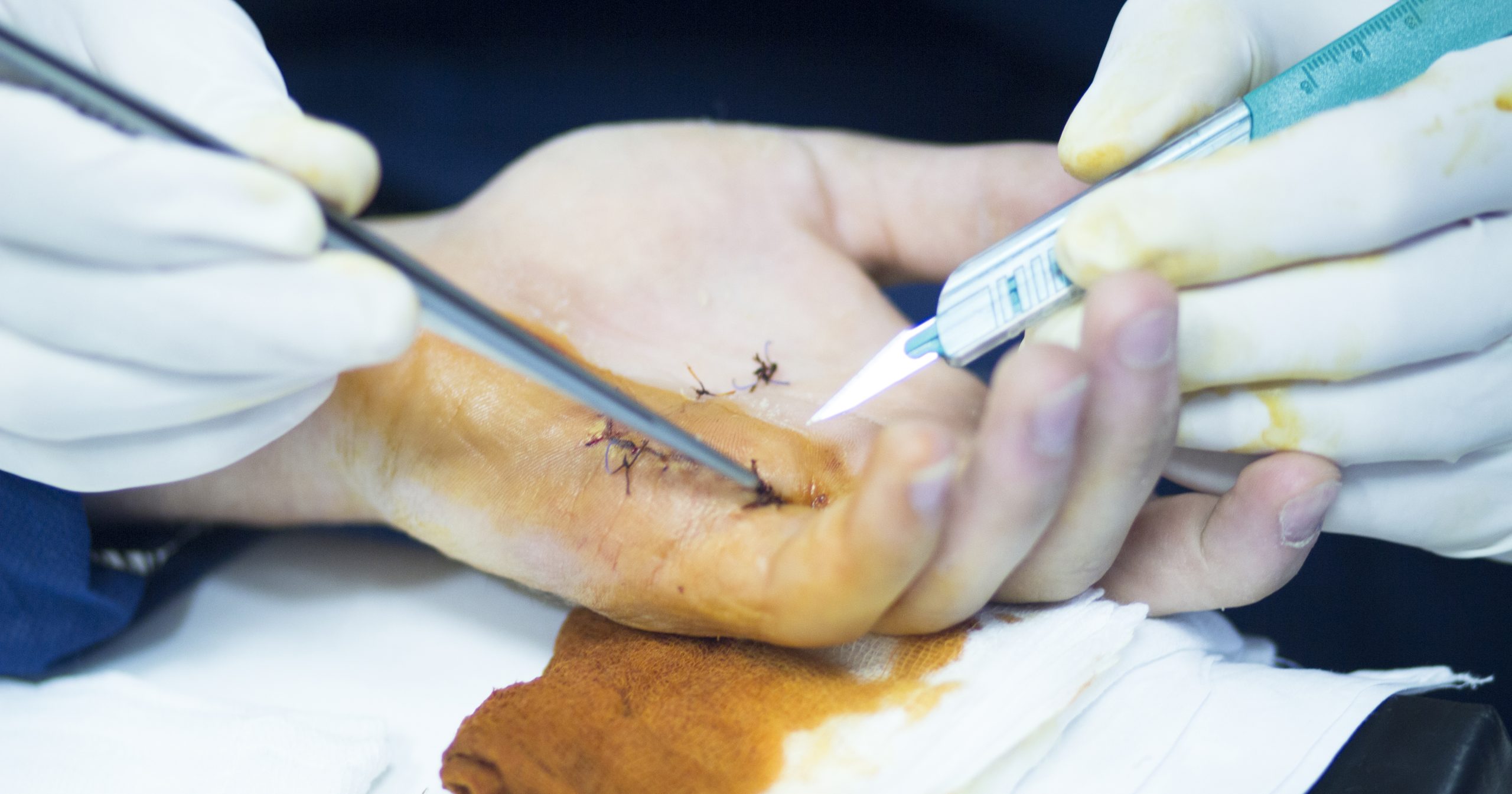 Hospital hand surgery orthopedics operation photo.